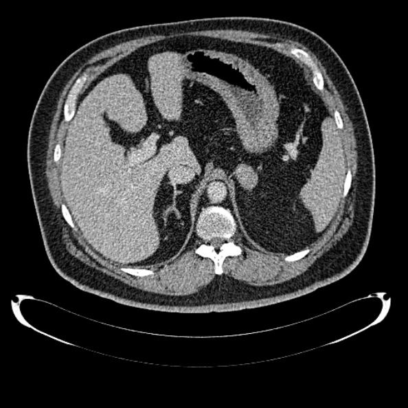 Bosniak renal cyst - type IV (Radiopaedia 24244-24518 C 73).jpg