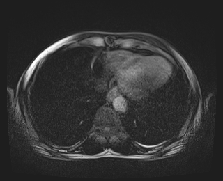Bouveret syndrome (Radiopaedia 61017-68856 Axial T1 fat sat 2).jpg