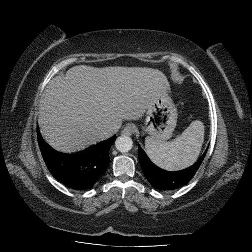 Bovine aortic arch - right internal mammary vein drains into the superior vena cava (Radiopaedia 63296-71875 A 140).jpg