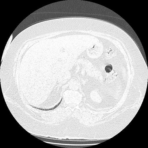 Bovine aortic arch - right internal mammary vein drains into the superior vena cava (Radiopaedia 63296-71875 Axial lung window 181).jpg
