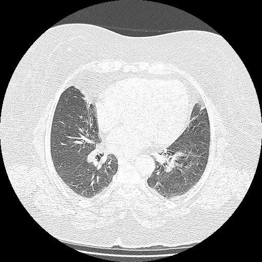 Bovine aortic arch - right internal mammary vein drains into the superior vena cava (Radiopaedia 63296-71875 Axial lung window 96).jpg