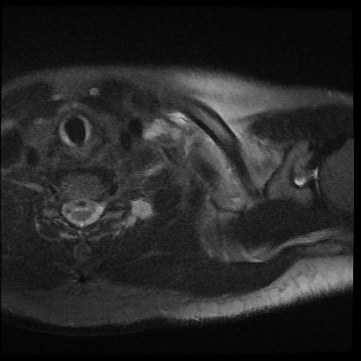 File:Brachial plexus neurofibroma (Radiopaedia 28030-28291 Axial T2 fat sat 12).png