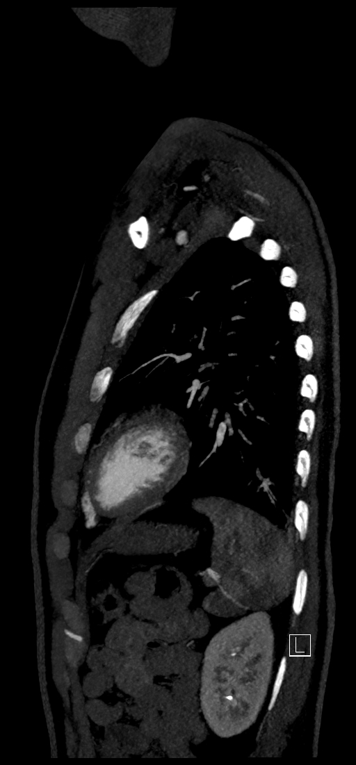 Brachiocephalic trunk pseudoaneurysm (Radiopaedia 70978-81191 C 73).jpg