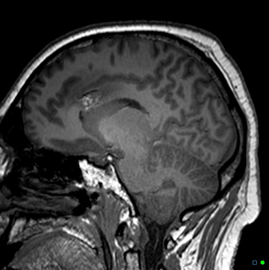 Brain death on MRI and CT angiography (Radiopaedia 42560-45689 Sagittal T1 15).jpg
