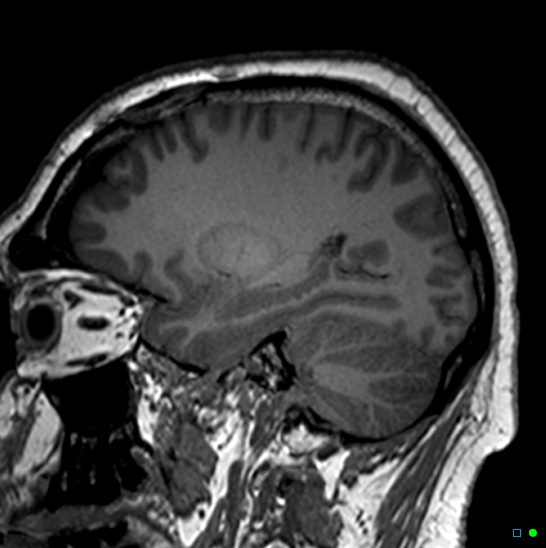 Brain death on MRI and CT angiography (Radiopaedia 42560-45689 Sagittal T1 53).jpg
