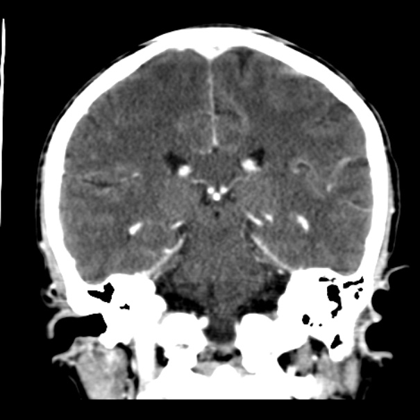 Brain metastases from lung cancer (Radiopaedia 24480-24781 Coronal C+ delayed 38).jpg