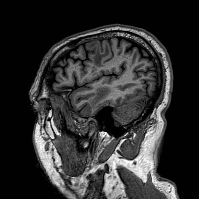 Brain metastases from lung cancer (Radiopaedia 83839-99028 Sagittal T1 107).jpg