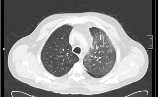 Brain metastases from squamocellular lung cancer (Radiopaedia 56515-63219 Axial lung window 20).jpg