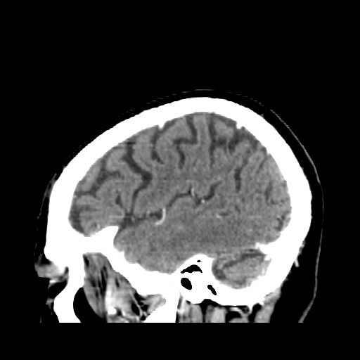 Brain metastasis (Radiopaedia 42617-45760 D 7).jpg
