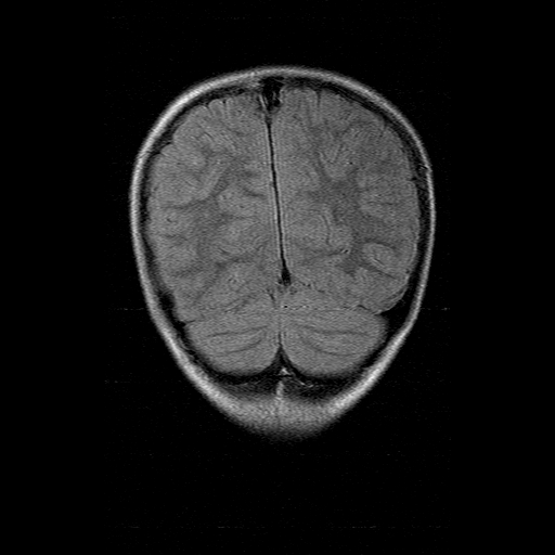 File:Brainstem ganglioglioma (Radiopaedia 10763-11224 Coronal FLAIR 4).jpg