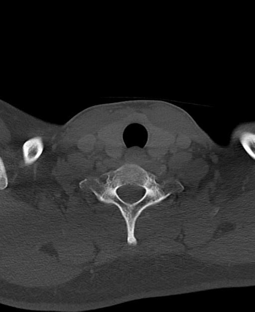 Branchial cleft cyst (Radiopaedia 31167-31875 Axial bone window 59).jpg