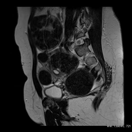 File:Broad ligament fibroid (Radiopaedia 49135-54241 Sagittal T2 9).jpg