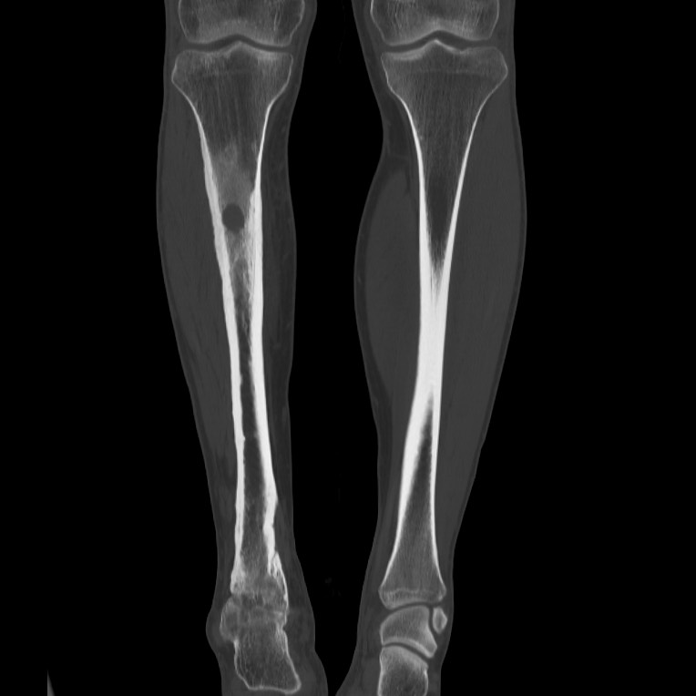 Brodie abscess - tibia (Radiopaedia 66028-75204 Coronal bone window 29).jpg