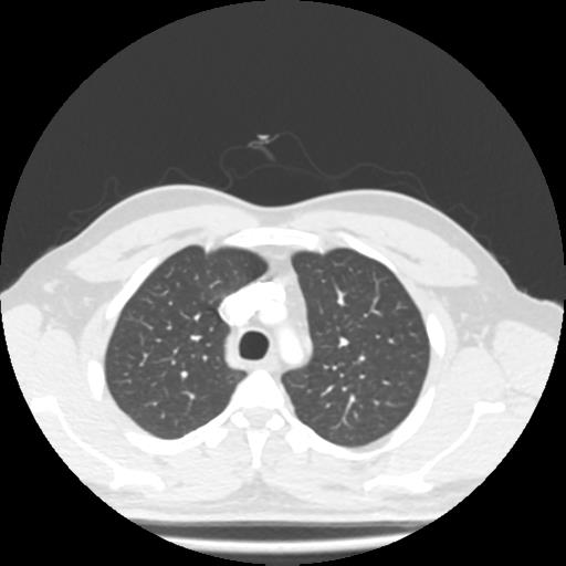 Bronchial carcinoid (Radiopaedia 80013-93291 Axial lung window 19).jpg