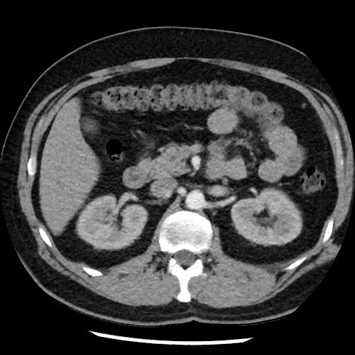 Bronchial carcinoid tumor (Radiopaedia 67377-76764 A 71).jpg