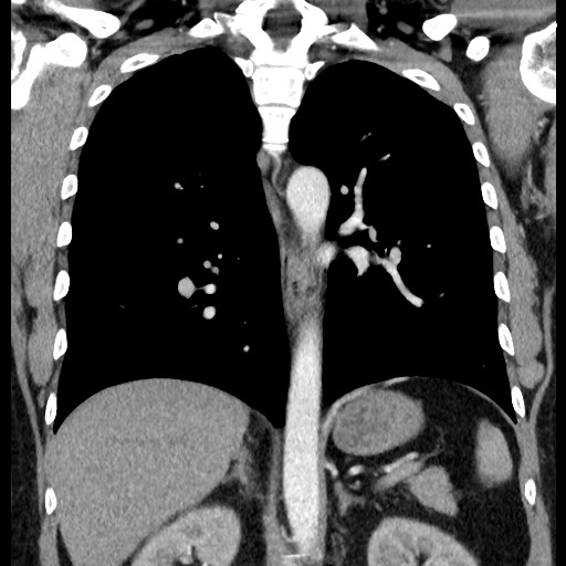 File:Bronchial carcinoid tumor (Radiopaedia 67377-76764 C 42).jpg