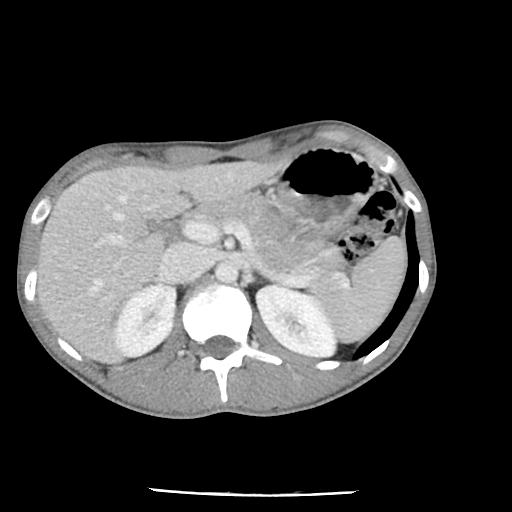 Bronchial carcinoid tumor causing right lower lobe collapse (Radiopaedia 83495-98594 A 57).jpg