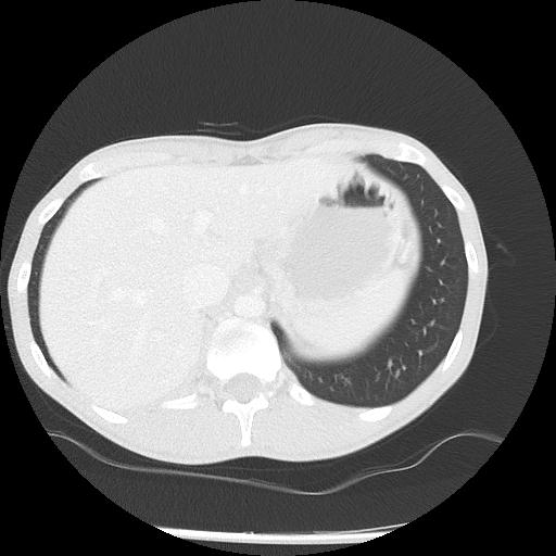 Bronchial carcinoid tumor causing right lower lobe collapse (Radiopaedia 83495-98594 Axial lung window 51).jpg