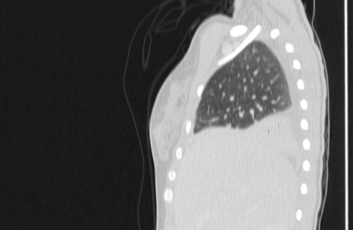 Bronchial mucoepidermoid carcinoma (Radiopaedia 57023-63895 Sagittal lung window 1).jpg