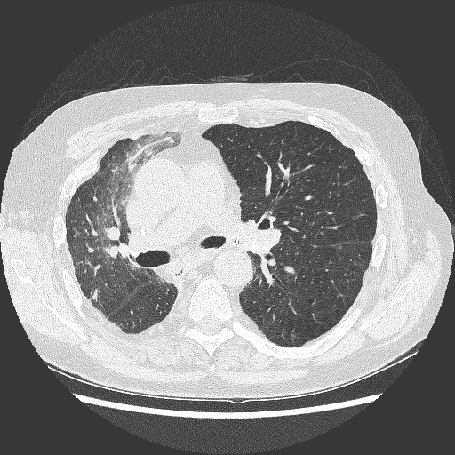 File:Bronchial stenosis - lung transplant (Radiopaedia 73133-83848 C 6).jpg