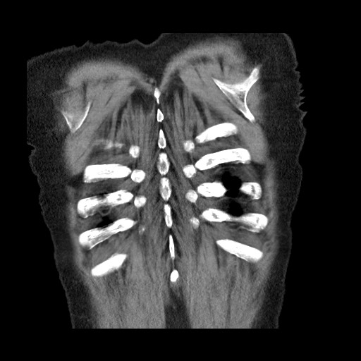 Bronchial stenosis - lung transplant (Radiopaedia 73133-83848 Coronal non-contrast 58).jpg