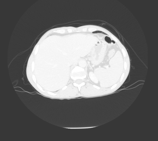 File:Bronchiectasis in Crohn disease (Radiopaedia 60311-67977 Axial lung window 35).jpg