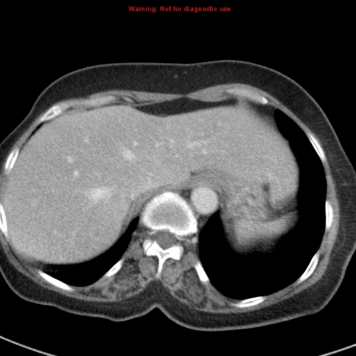 File:Bronchoalveolar carcinoma (BAC) (Radiopaedia 13436-13392 B 47).jpg