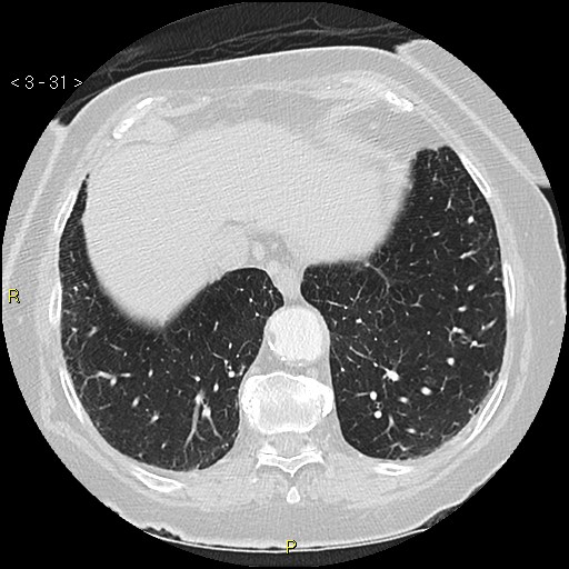 Bronchogenic carcinoma as an incidental finding (Radiopaedia 16453-16130 Axial lung window 31).jpg