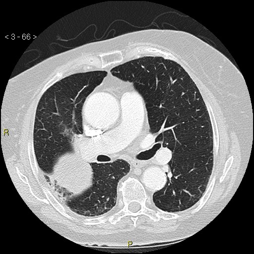 Bronchogenic carcinoma as an incidental finding (Radiopaedia 16453-16130 Axial lung window 66).jpg