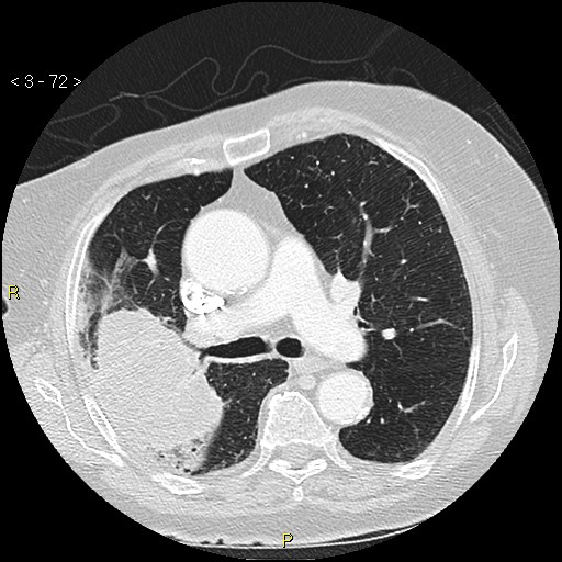 Bronchogenic carcinoma as an incidental finding (Radiopaedia 16453-16130 Axial lung window 72).jpg