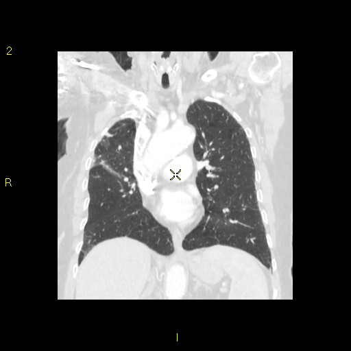 File:Bronchogenic carcinoma as an incidental finding (Radiopaedia 16453-16130 Coronal lung window 26).jpg
