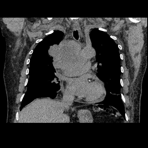 File:Bronchogenic carcinoma with metastatic lymphadenopathy (Radiopaedia 37671-39569 Coronal non-contrast 22).jpg