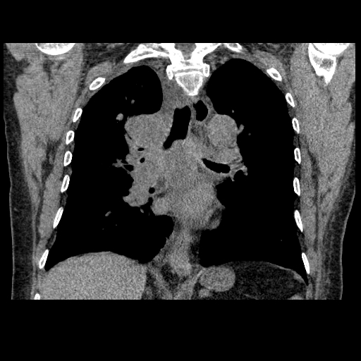 File:Bronchogenic carcinoma with metastatic lymphadenopathy (Radiopaedia 37671-39569 Coronal non-contrast 27).jpg