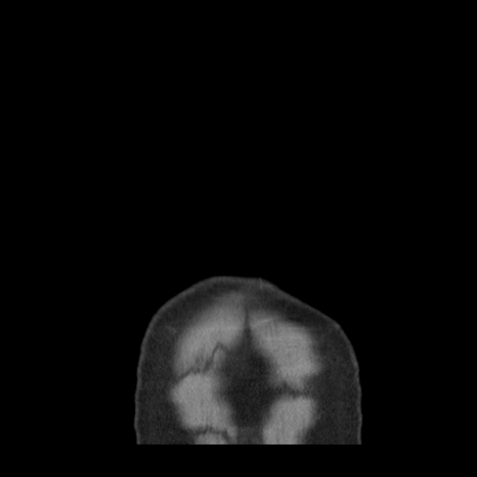 Bronchogenic carcinoma with upper lobe collapse (Radiopaedia 29297-29726 D 1).jpg
