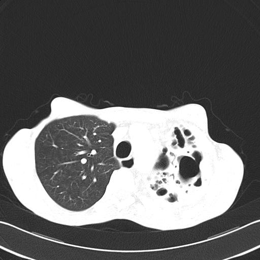 Bronchopleural fistula secondary to tuberculosis (Radiopaedia 20415-20322 Axial lung window 19).jpg