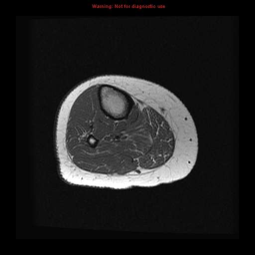 File:Brown tumor (Radiopaedia 12318-12597 Axial T1 19).jpg