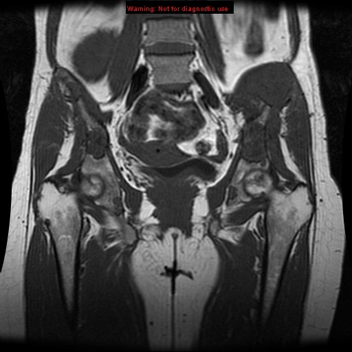 File:Brown tumors (Radiopaedia 9666-10290 Coronal T1 15).jpg