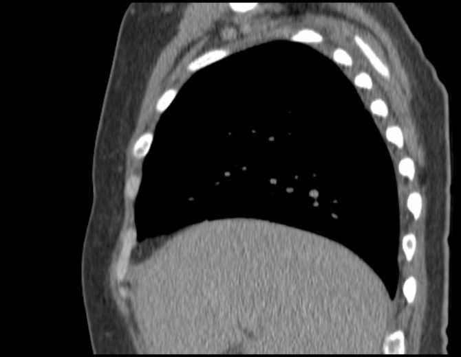 File:Brown tumors compressing the spinal cord (Radiopaedia 68442-77988 B 18).jpg