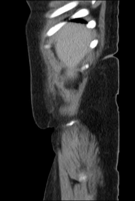 Brown tumors compressing the spinal cord (Radiopaedia 68442-77988 F 6).jpg