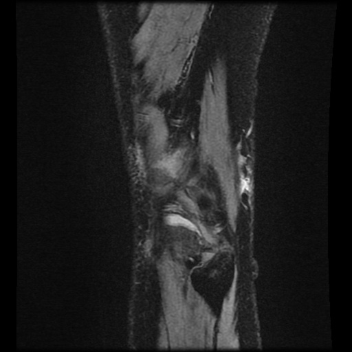 Bucket handle meniscus tear (Radiopaedia 56916-63751 H 2).jpg