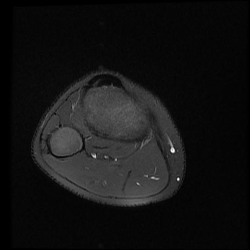 File:Bucket handle tear - lateral meniscus (Radiopaedia 72124-82634 Axial PD fat sat 16).jpg