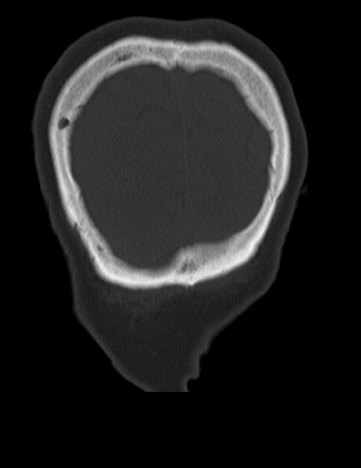 Burnt-out meningioma (Radiopaedia 51557-57337 Coronal bone window 50).jpg
