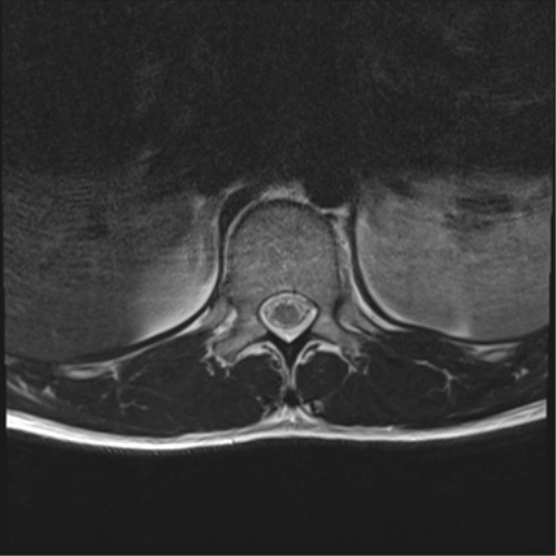File:Burst fracture - T12 with conus compression (Radiopaedia 56825-63646 Axial T2 21).png