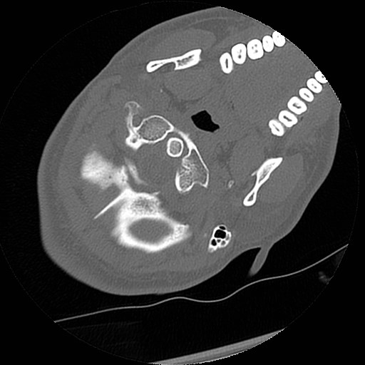C1-C2 "subluxation" - normal cervical anatomy at maximum head rotation (Radiopaedia 42483-45607 Axial non-contrast 53).jpg