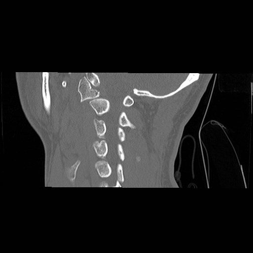 File:C1-C2 "subluxation" - normal cervical anatomy at maximum head rotation (Radiopaedia 42483-45607 C 21).jpg