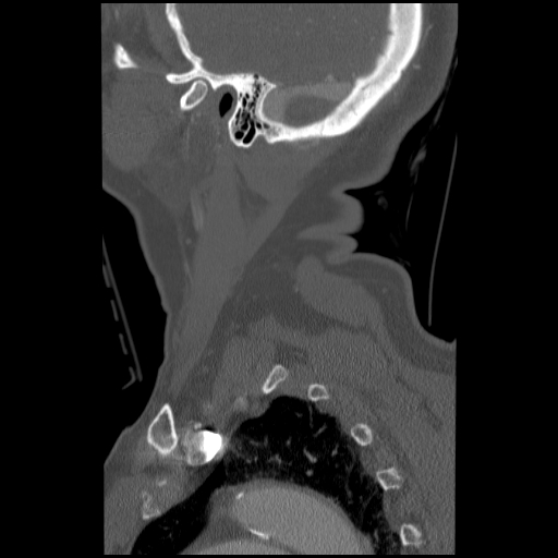File:C1 anterior arch (plough) fracture - type 1 (Radiopaedia 76181-87720 Sagittal bone window 18).jpg