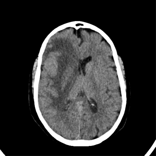 File:CNS Lymphoma (Radiopaedia 44198-47794 Axial non-contrast 21).png