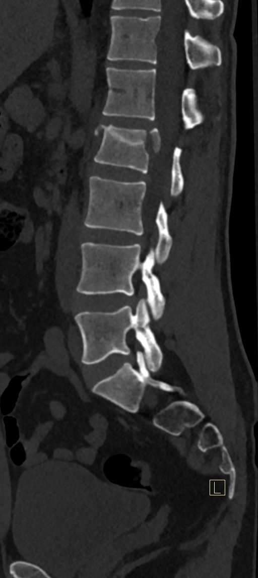 Calcaneal fractures with associated L2 burst fracture (Radiopaedia 71671-82493 Sagittal bone window 32).jpg