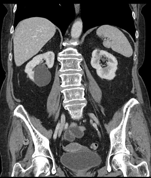 Calcified adrenal glands and Spigelian hernia (Radiopaedia 49741-54988 B 71).jpg