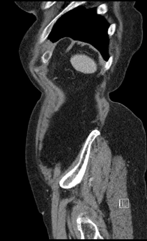 Calcified adrenal glands and Spigelian hernia (Radiopaedia 49741-54988 C 20).jpg